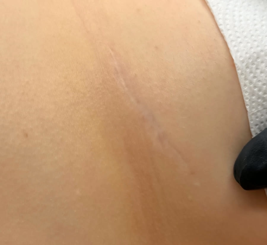 Helle, flache und verheilte Narbe vor der Camouflage Pigmentierung